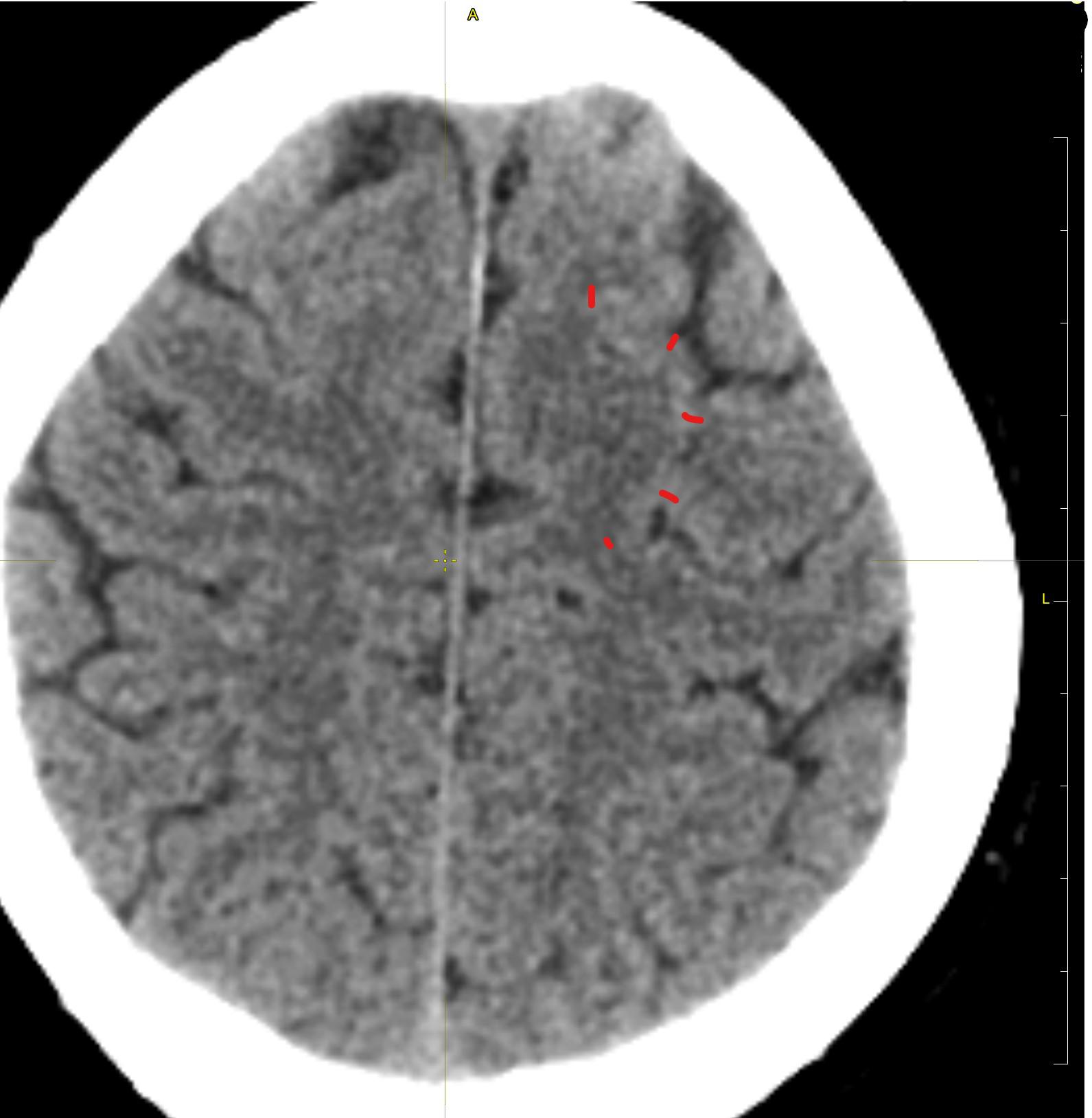 CT, 2.5mm Nativ.